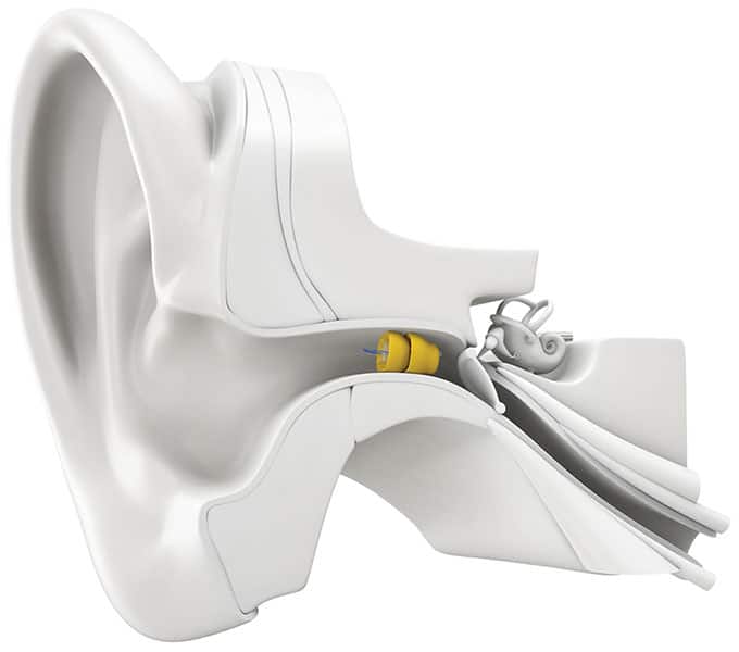 Phonak Lyric hearing aid in ear model