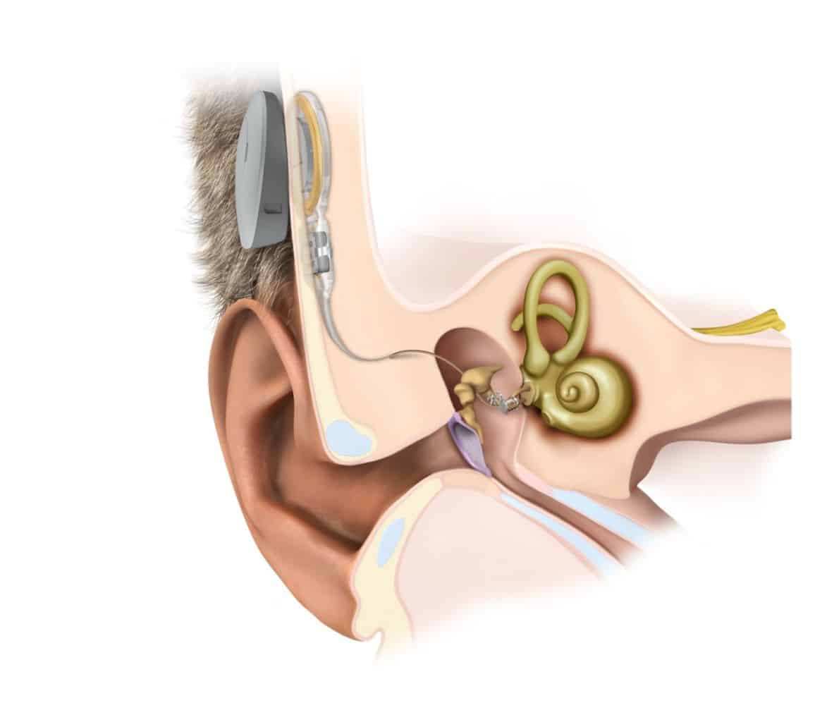 Med-el ear anatomy with samba2 soundbridge