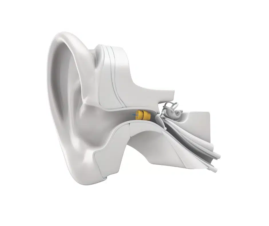 Phonak Lyric in white ear diagram